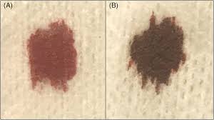 <p>Hemolytic anemia, methemoglobinemia, dark-colored urine, icterus, facial edema, lethargy</p>