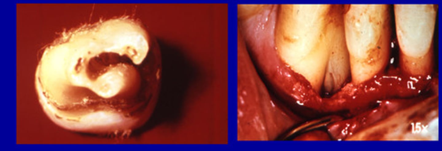 <p>bone loss between the roots of multi-rooted teeth</p>