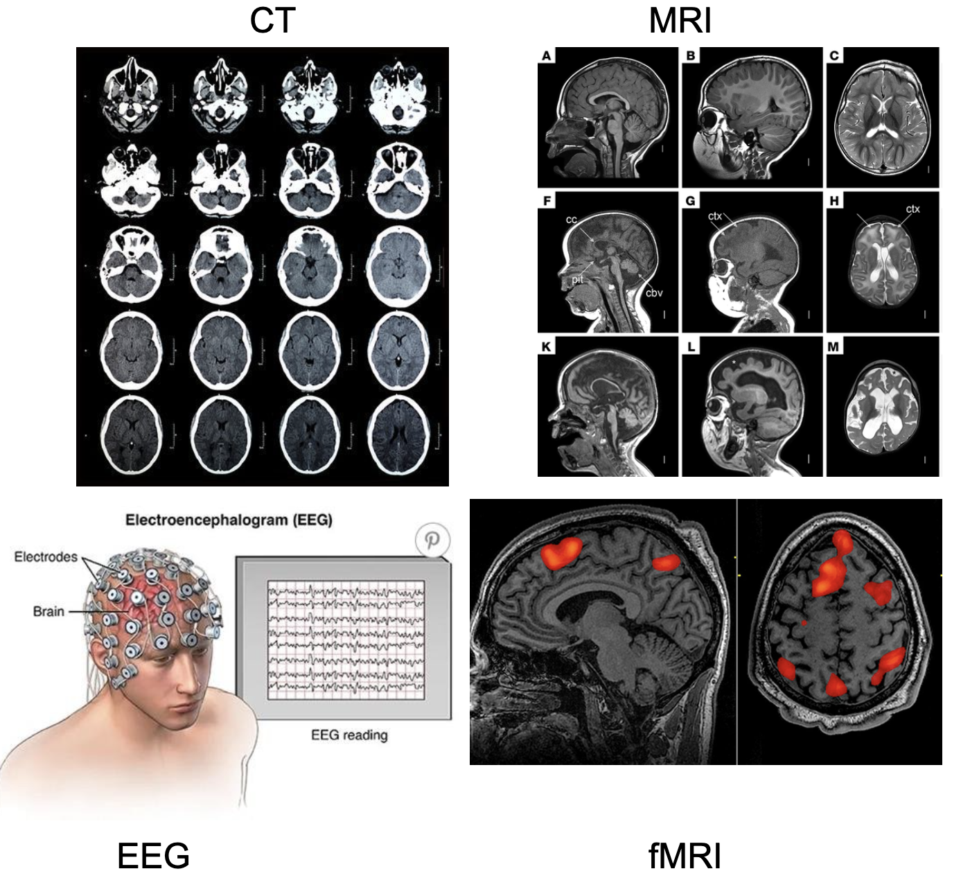 <ul><li><p>MRI (magnetic resonance imaging) - uses strong magnetic fields, magnetic field gradients, and radio waves to generate images of the organs in the body -fMRI (functional MRI) - measures brain activity by detecting changes associated with blood flow</p></li><li><p>CT (computed tomography) - combines a series of X-ray images taken from different angles around the body and uses computer processing to create cross-sectional images (slices) of the bones, blood vessels and soft tissues inside the body</p></li><li><p>EEG (electroencephalogram) - records/measures electrical activities through electrodes attached to the scalp</p></li></ul>