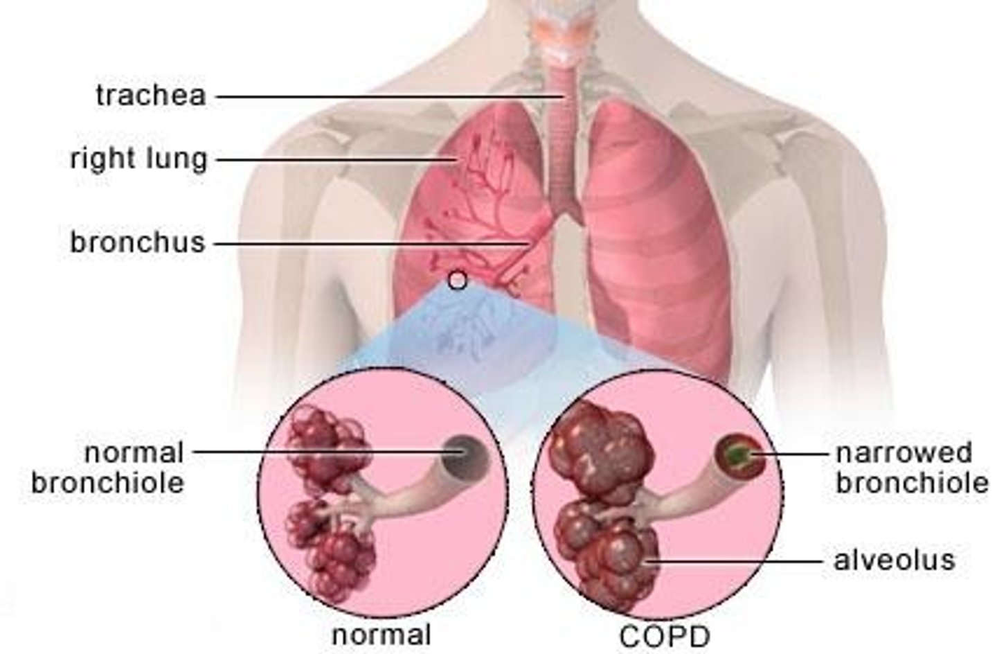 <p>A group of lung diseases that block airflow and make breathing difficult; commonly seen in smokers.</p>