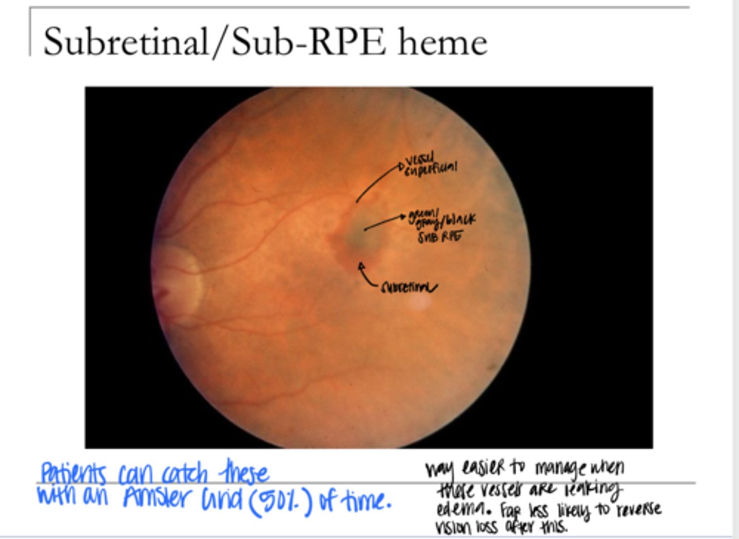 <p>Sub-RPE/Subretinal Heme (Pic)</p>
