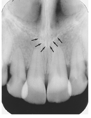 <p><span><span>·</span></span><span style="font-family: "Times New Roman"; line-height: normal; font-size: 7pt;"><span> </span></span><span><span>A sharp projection of the maxilla located at the anterior and inferior portion of the nasal cavity</span></span></p><p class="MsoListParagraphCxSpLast"><span><span>·</span></span><span style="font-family: "Times New Roman"; line-height: normal; font-size: 7pt;"><span> </span></span><span><span>A v-shaped radiopaque area located at the intersection of the floor of the nasal cavity and nasal septum</span></span></p>