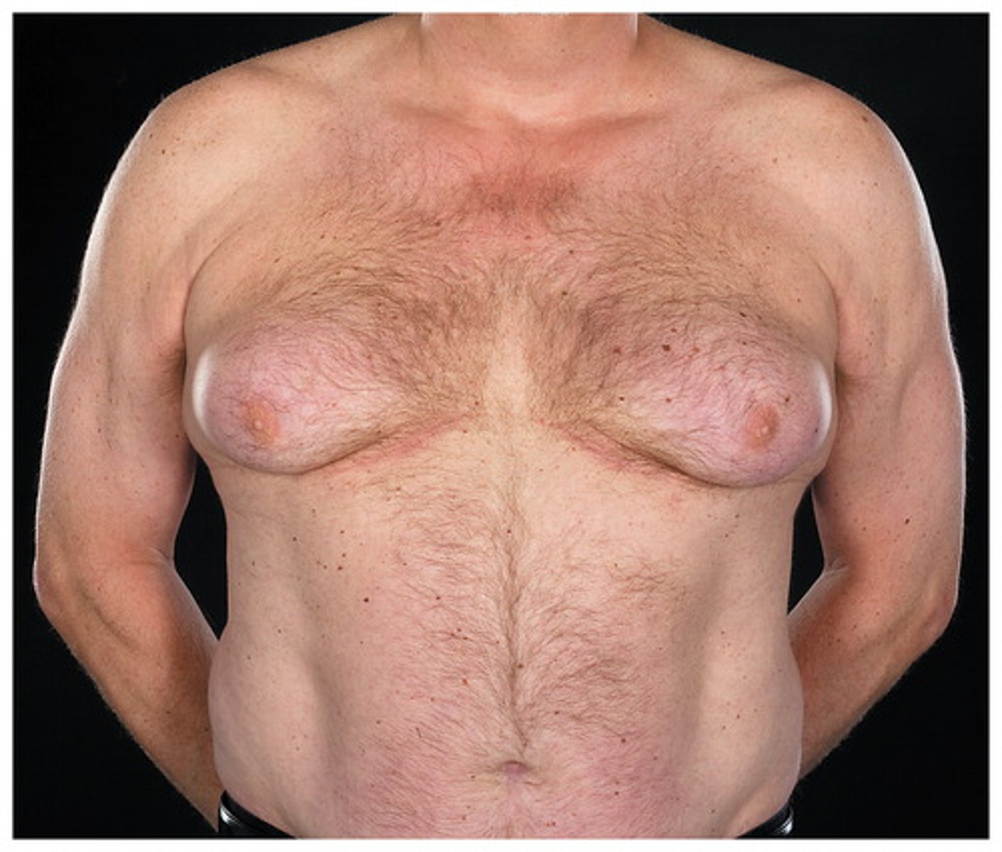 <p>enlargement of the breast</p>