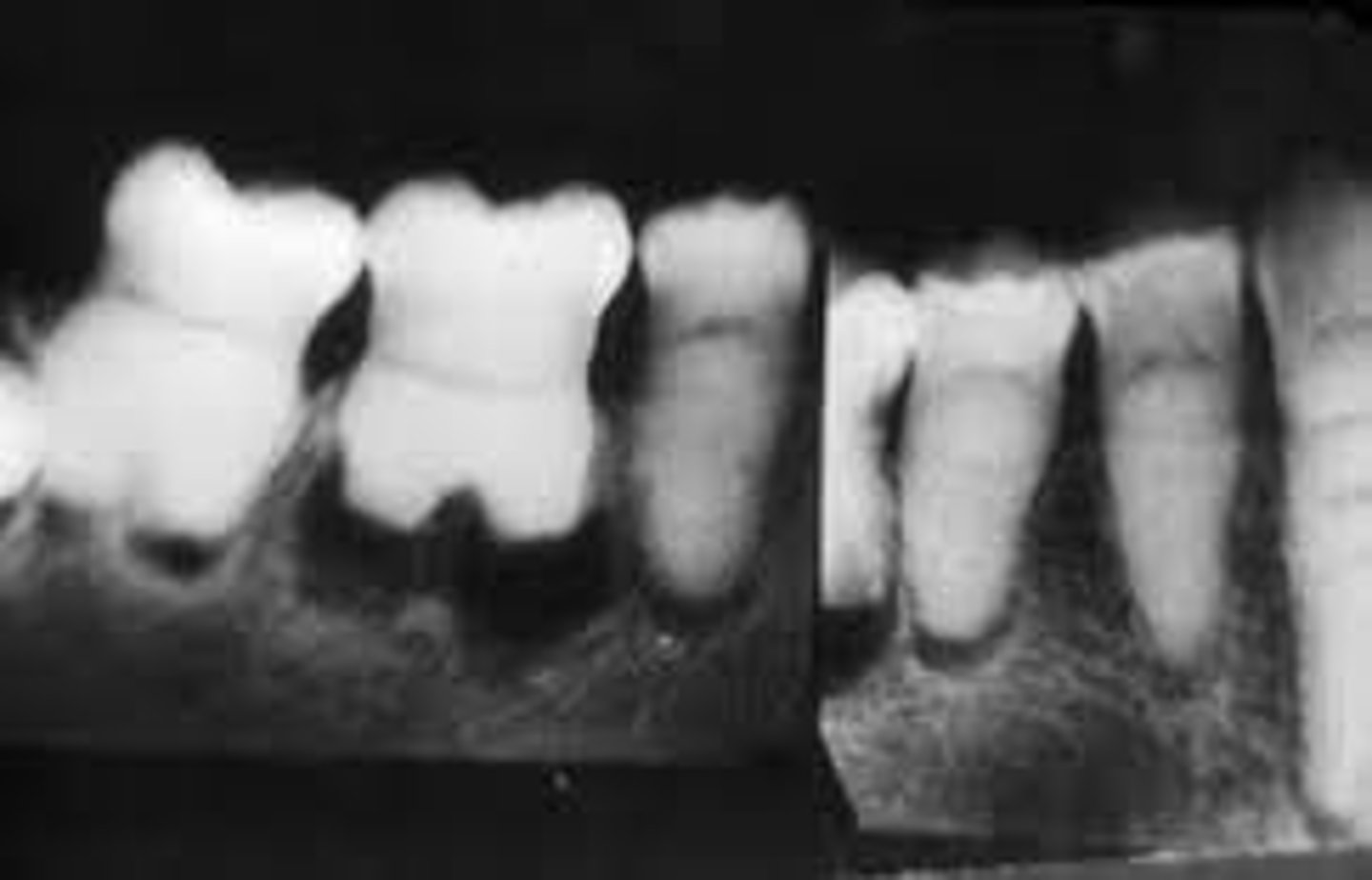 <p>Dentin Dysplasia</p>