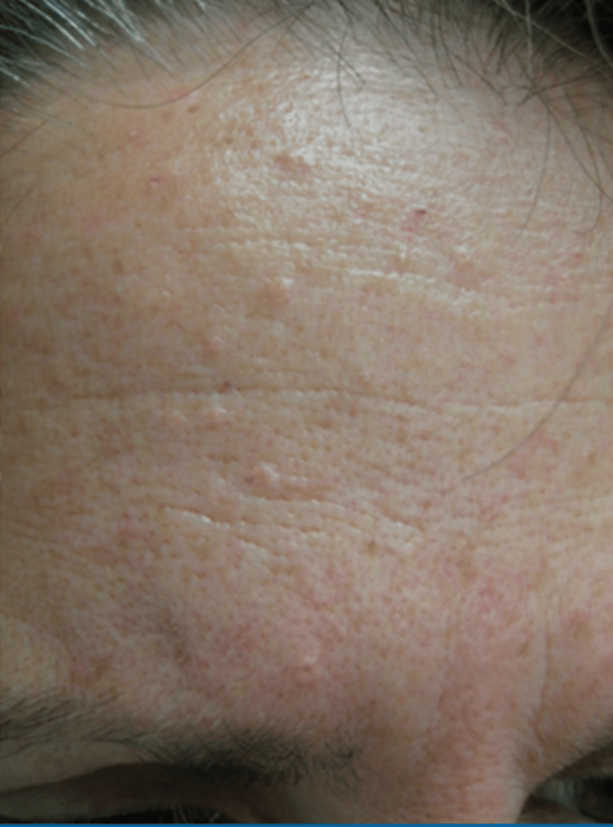 <p>yellow colored lesion with umbilication due to gland growth around central hair follicle</p>