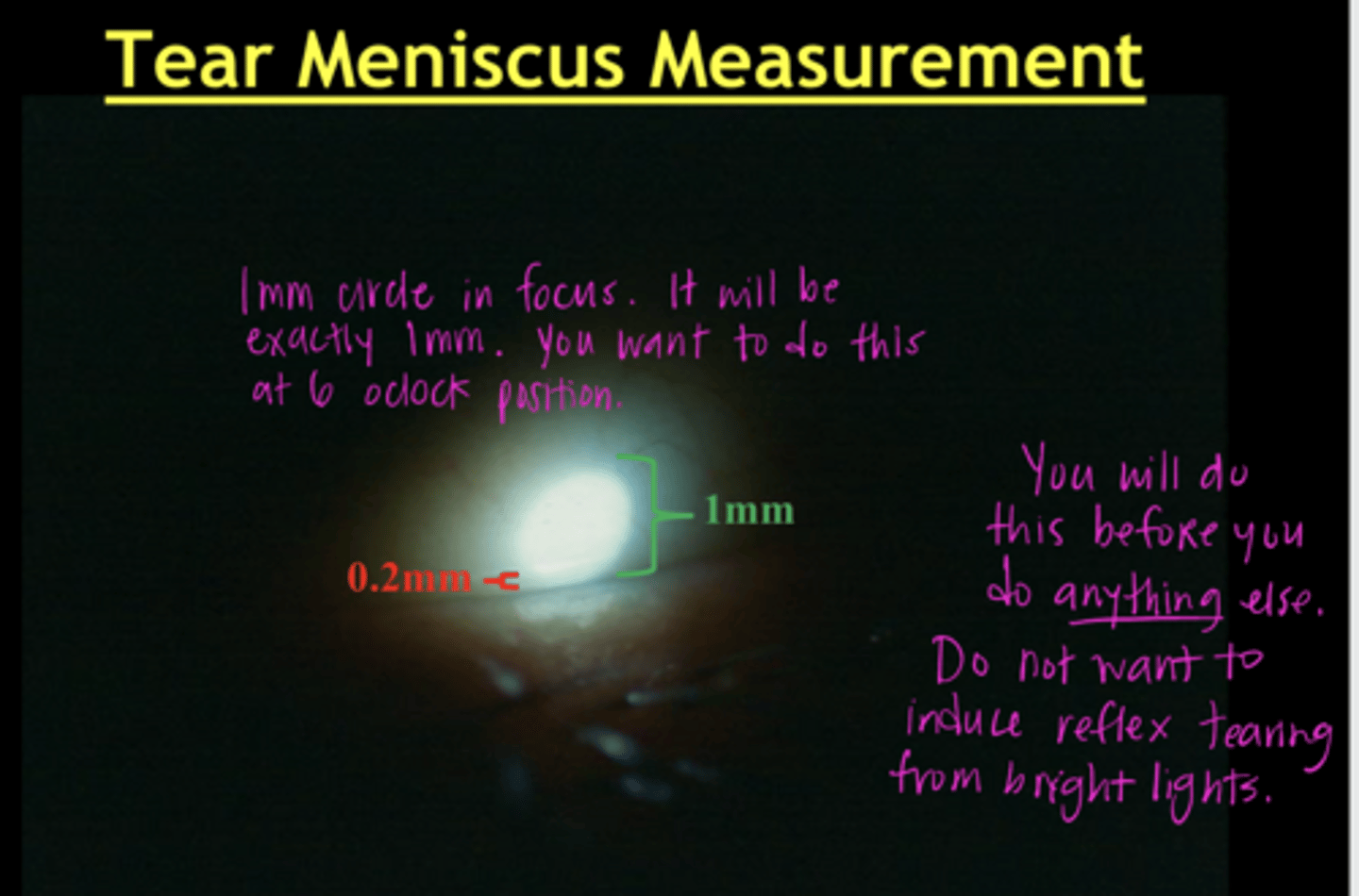 <p>Tear Meniscus Measurement (Pic)</p>