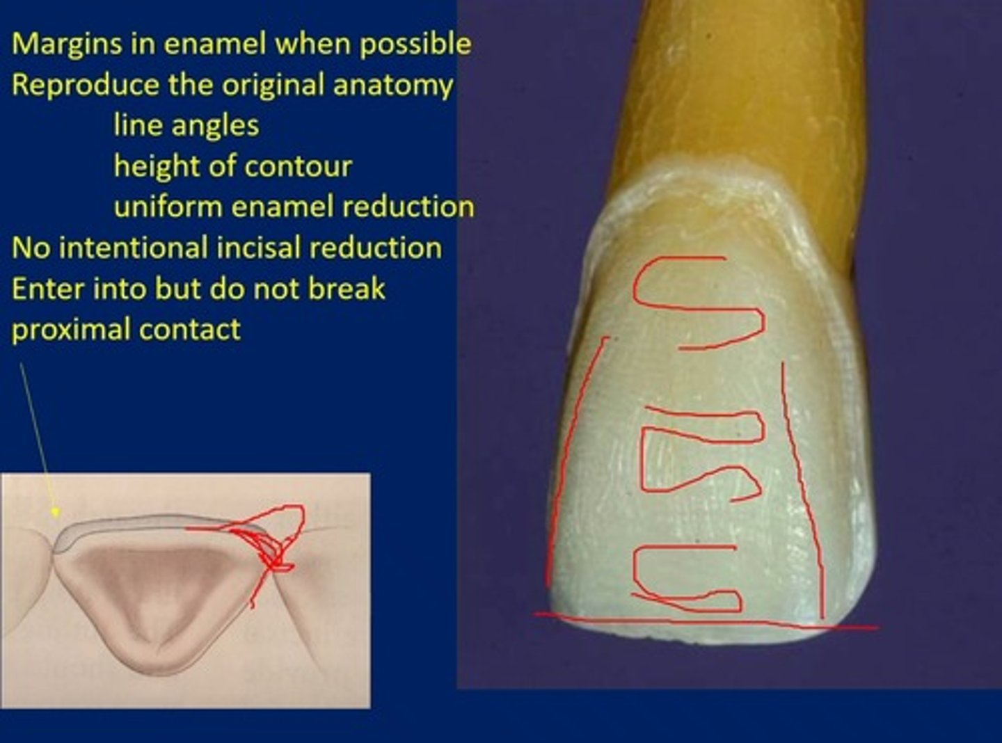 <p>when doing an enameloplasty on, for example, a rotated tooth to make it symmetrical with the adjacent tooth</p>