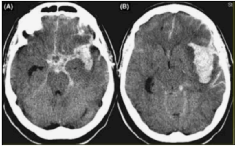 <p>Subarachnoid Hemorrhages</p>