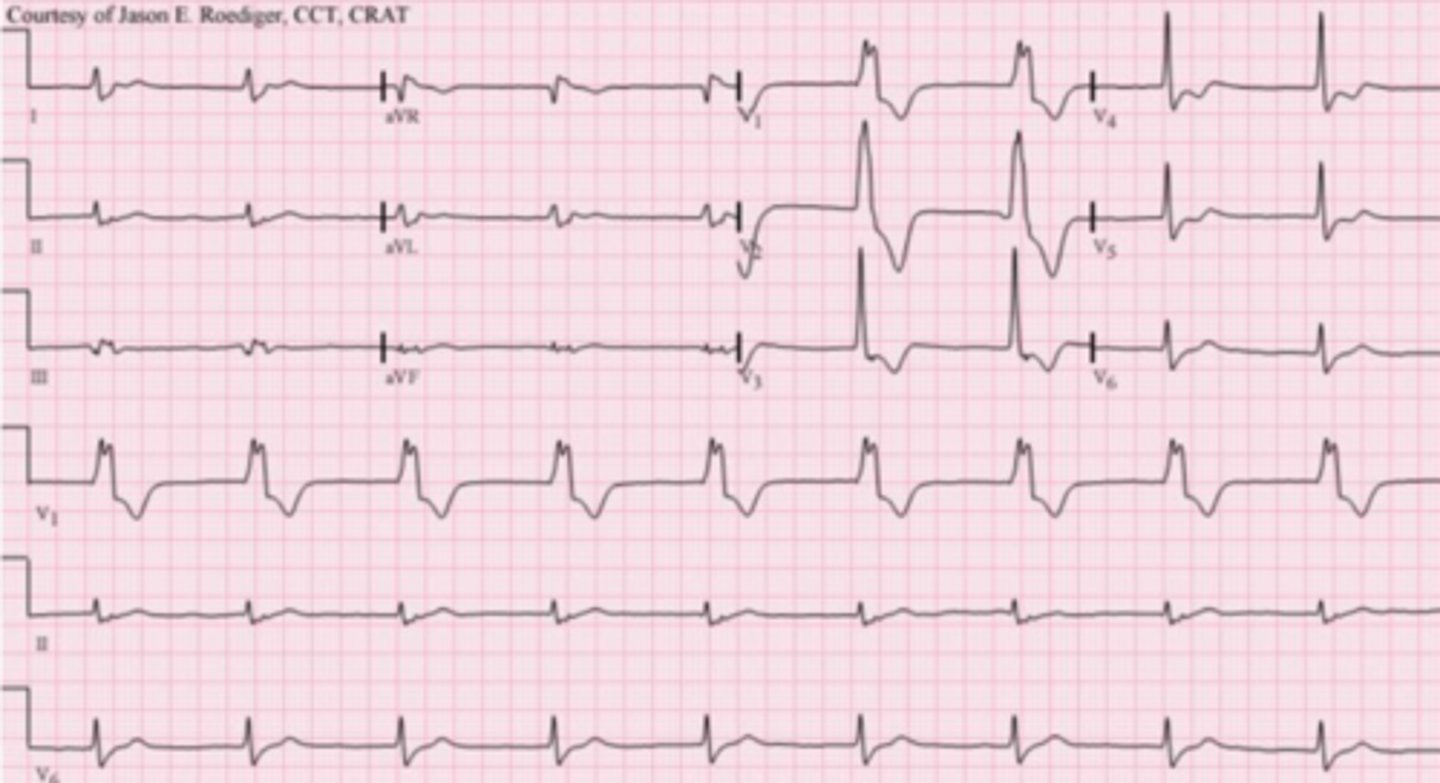 <p>What is an accelerated idioventricular rhythm</p>
