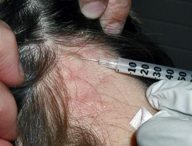 <p><strong>Treatment for Alopecia Areata</strong></p><p>-No FDA approved treatment</p><p>-Intralesional ___________ have been shown to have good results</p><p>-_________ glucocorticosteroids, prescribe only if you would have to inject a lot of the intralesional corticosteroids </p><p>-Hair ________, wigs, hair pieces, skin grafts, laser therapy, and plasma therapy are other treatment options</p>