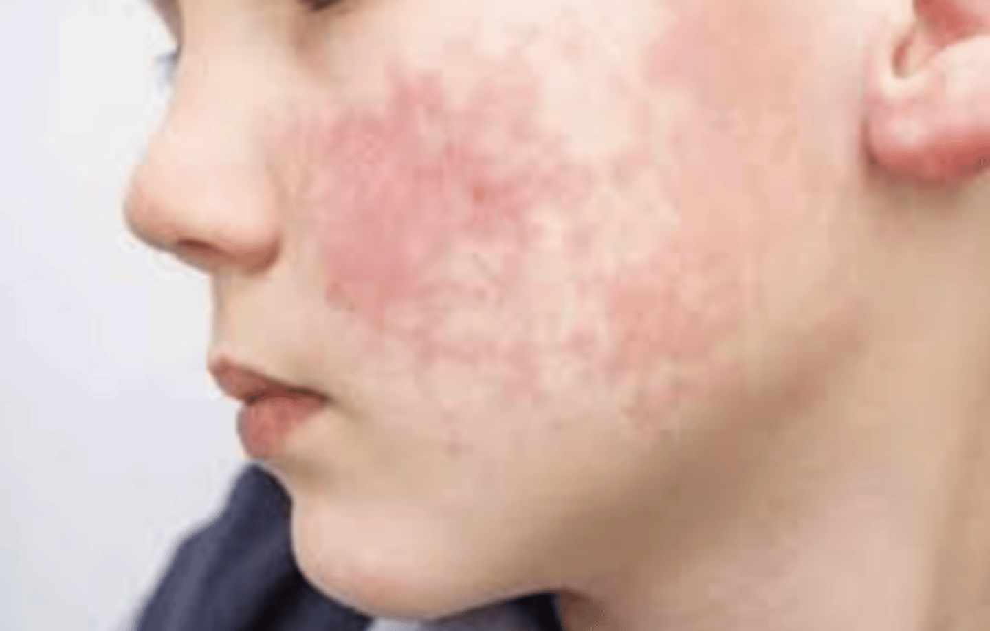 <p>-slapped cheek</p>