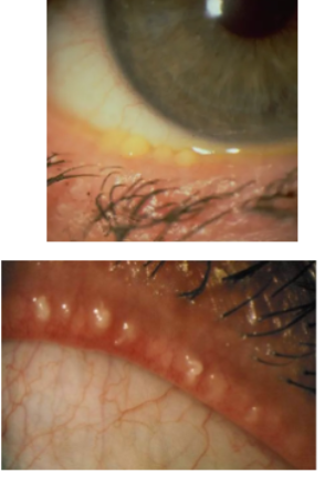 <p>posterior blepharitis/ meibomian gland dysfunction</p>
