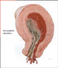 - fertilized egg cannot progress past an early embryo. 
- the hybrid does not survive. 
- spontaneous abortions or ends in stillbirth