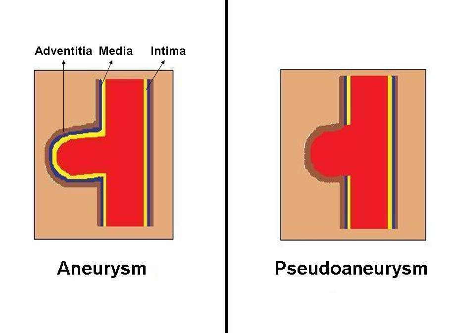 <p>Hematoma</p>