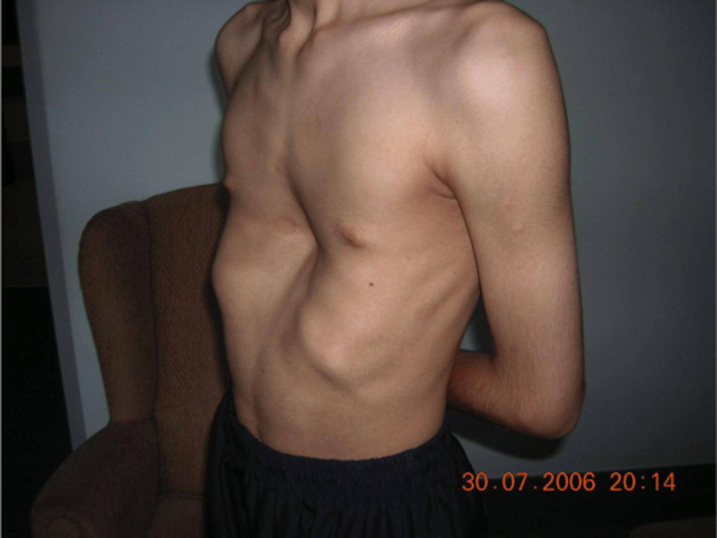 <p>funnel chest - depression of the chest inwards</p>