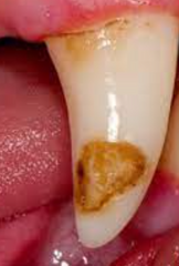 <p>What is this condition of minimal calcification of the enamel?</p>