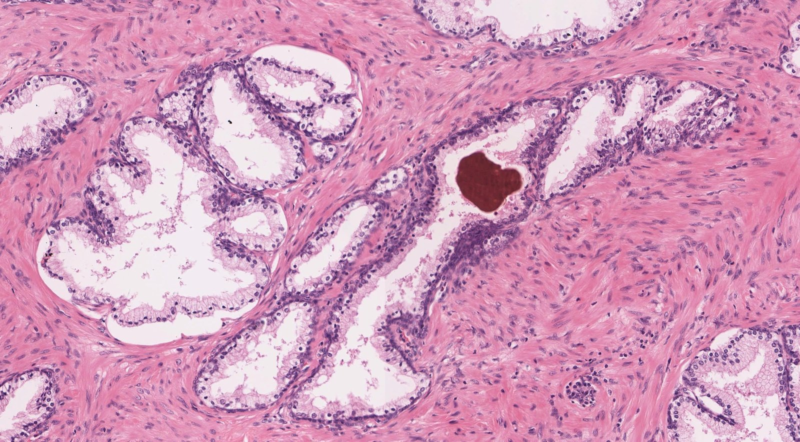<p>D. Prostate</p>