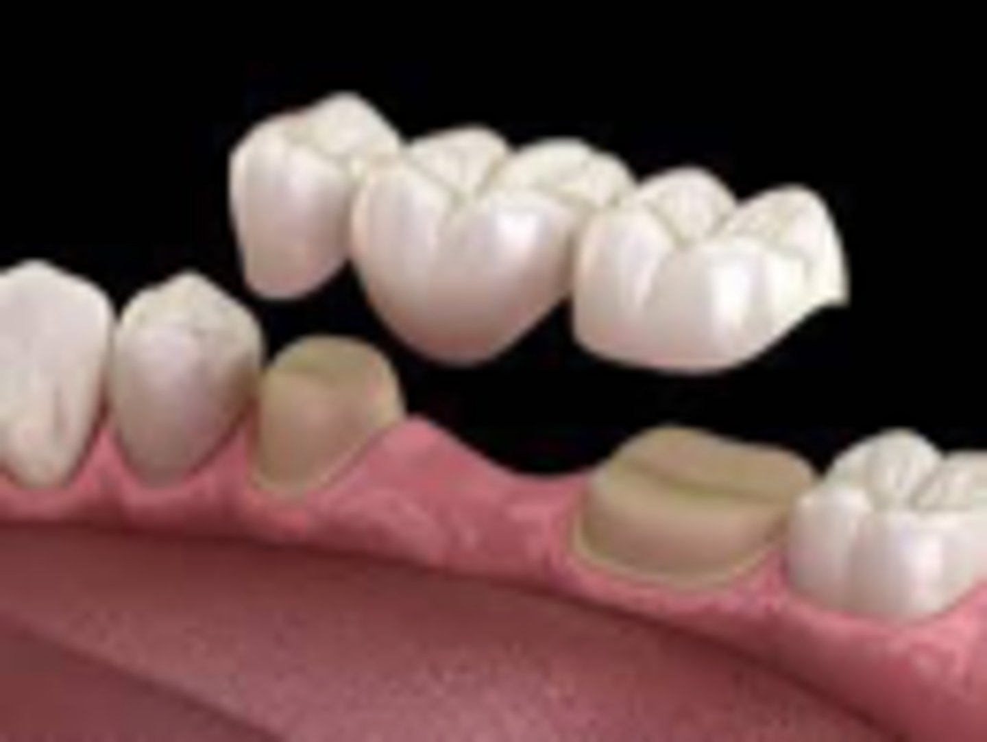 <p>Cannot be removed from the mouth by the patient</p>