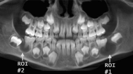 <p>What type of cyst is the buccal bifurcation cyst?</p>
