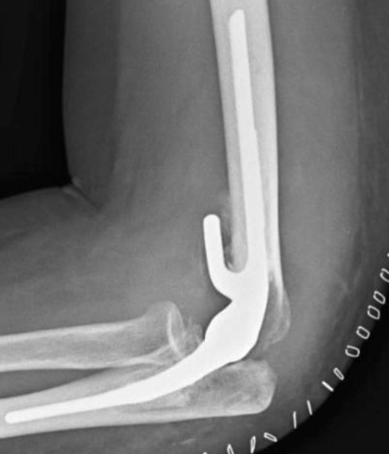 <p>indications for Total Elbow Arthroplasty </p>