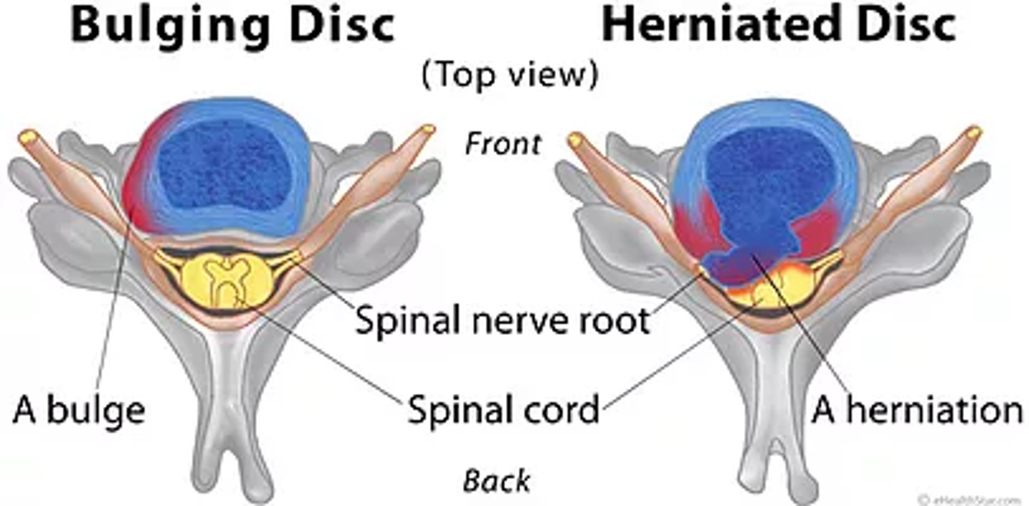 <p>Bulging = annulus protrudes; Herniated = nucleus pulposus breaks through annulus.</p>