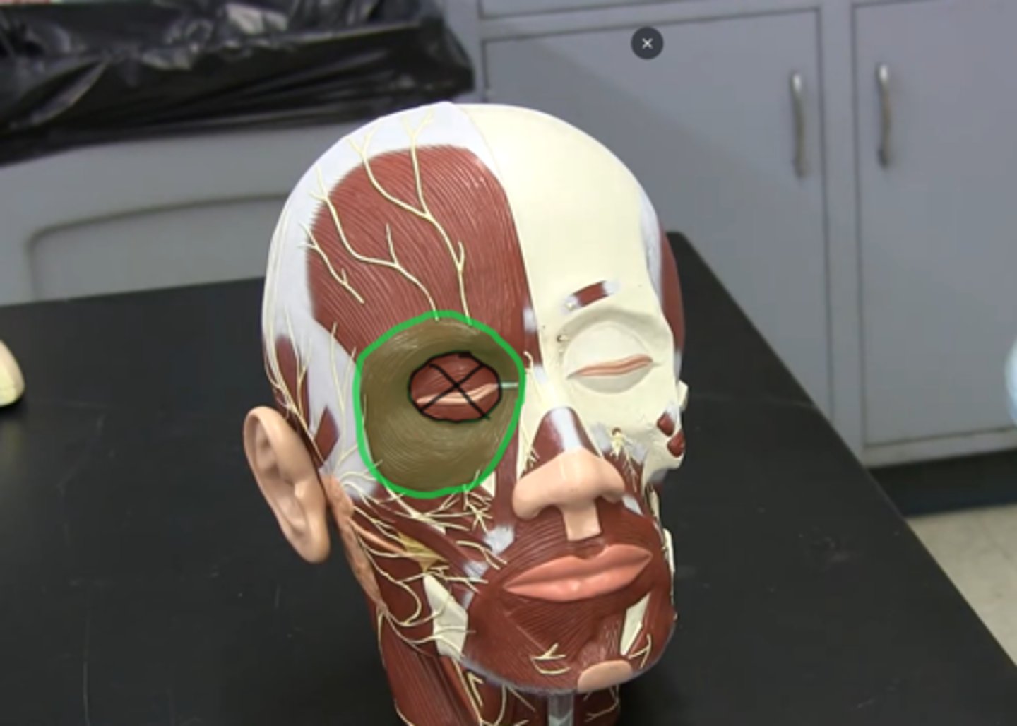 <p>All around the eye; does not include eyelid.</p>