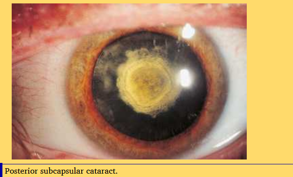 <p>in the middle at the back</p><p>located beneath posterior capsule </p><p>impacts vision early and significantly along visual axis </p><p>risk factor is high dose steriod use </p>