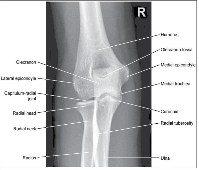 <p><span style="line-height: normal;"><span>• </span></span>Radial head, neck& tuberosity are slightly (approx. 0.6 cm) superimposed over the proximal ulna</p><ul><li><p class="p1"><span style="line-height: normal;"><span> </span></span>Medial rotation causes too much superimposition</p></li><li><p class="p1"><span style="line-height: normal;"><span> </span></span>Lateral rotation causes too little superimposition</p></li></ul><p class="p1"><span style="line-height: normal;"><span>• </span></span>Radial tuberosity in profile medially</p><p class="p1"><span style="line-height: normal;"><span>• </span></span>Olecranon located in the olecranon fossa</p><p class="p1"><span style="line-height: normal;"><span>• </span></span>No rotation of humeral epicondyles</p>