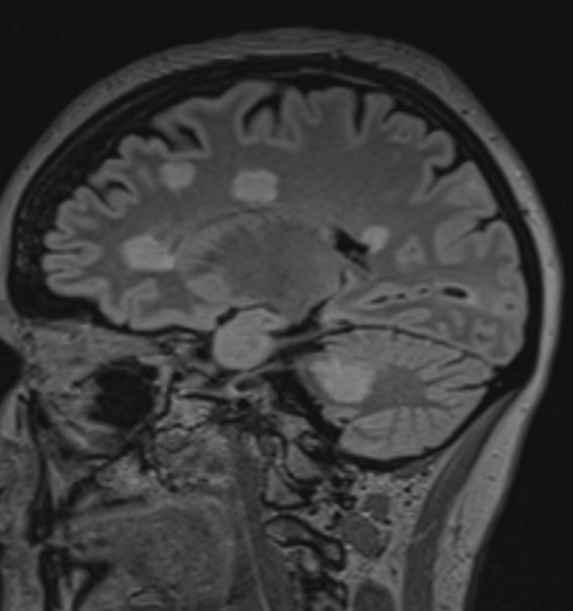 <p>Focal hyperintensity on T2-weighted imaging, round to ovoid shape, 3mm to <1-2 cm in size, and generally asymmetric distribution.</p>
