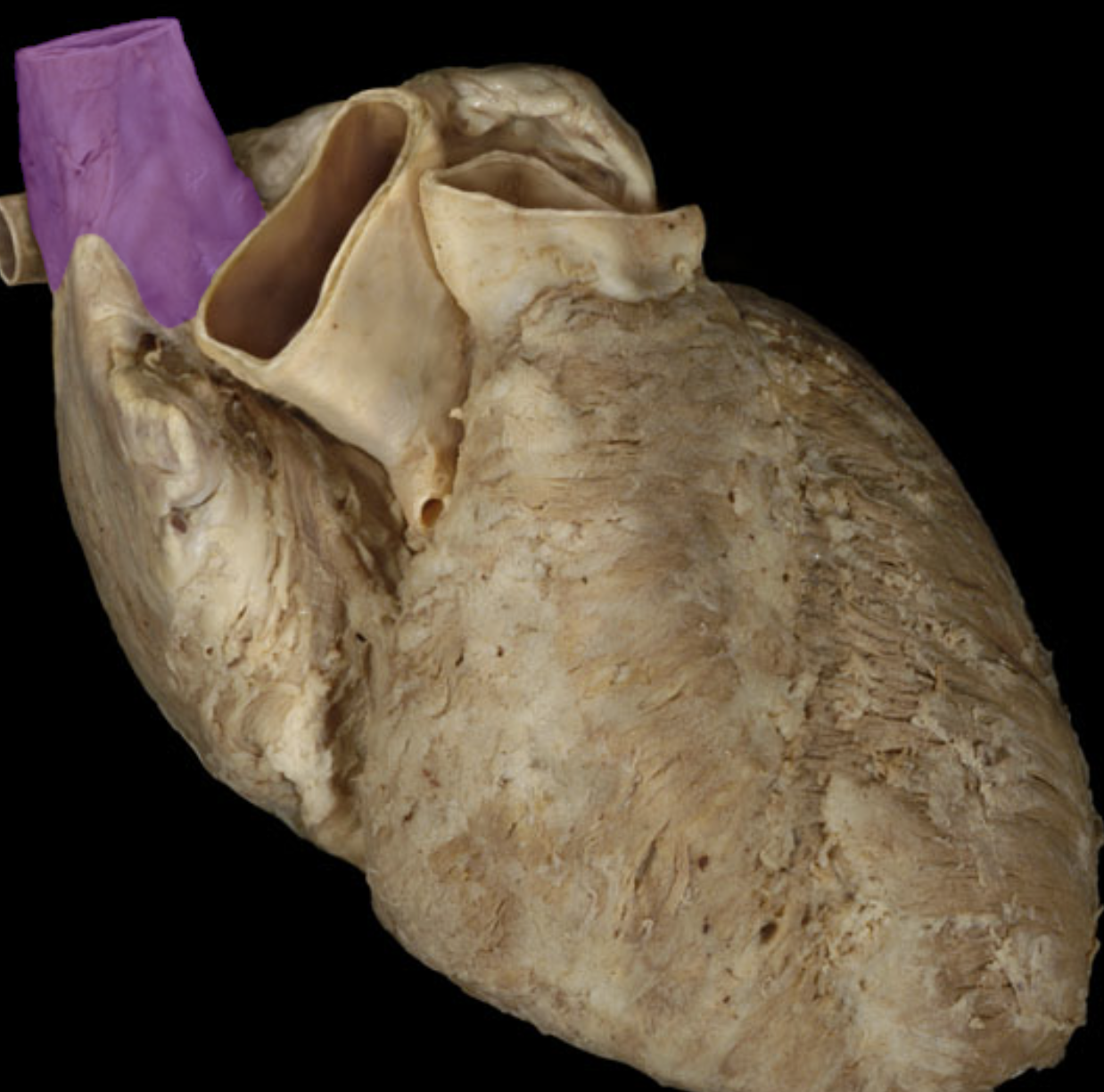 <p>Superior vena cava</p>