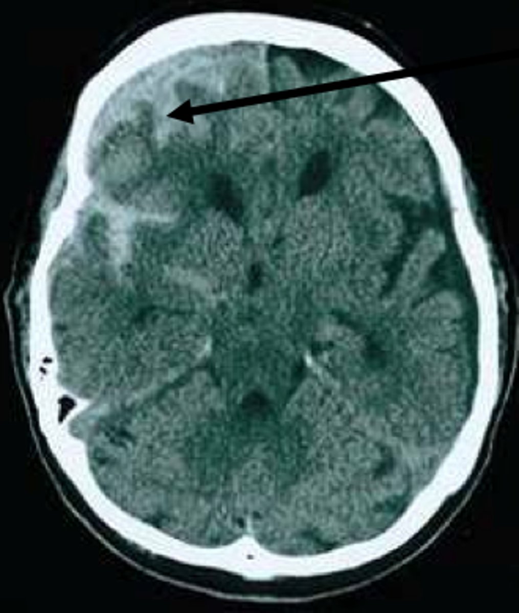 <p>Admission &amp; neurosurgery consult, repeat head CT within 24 hrs, aggressive management of HTN (very important), pain management</p>