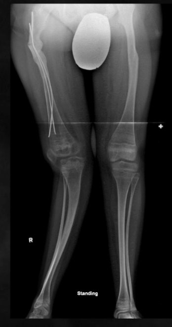 <p>what is seen here for this case of osteogenesis imperfecta?</p>