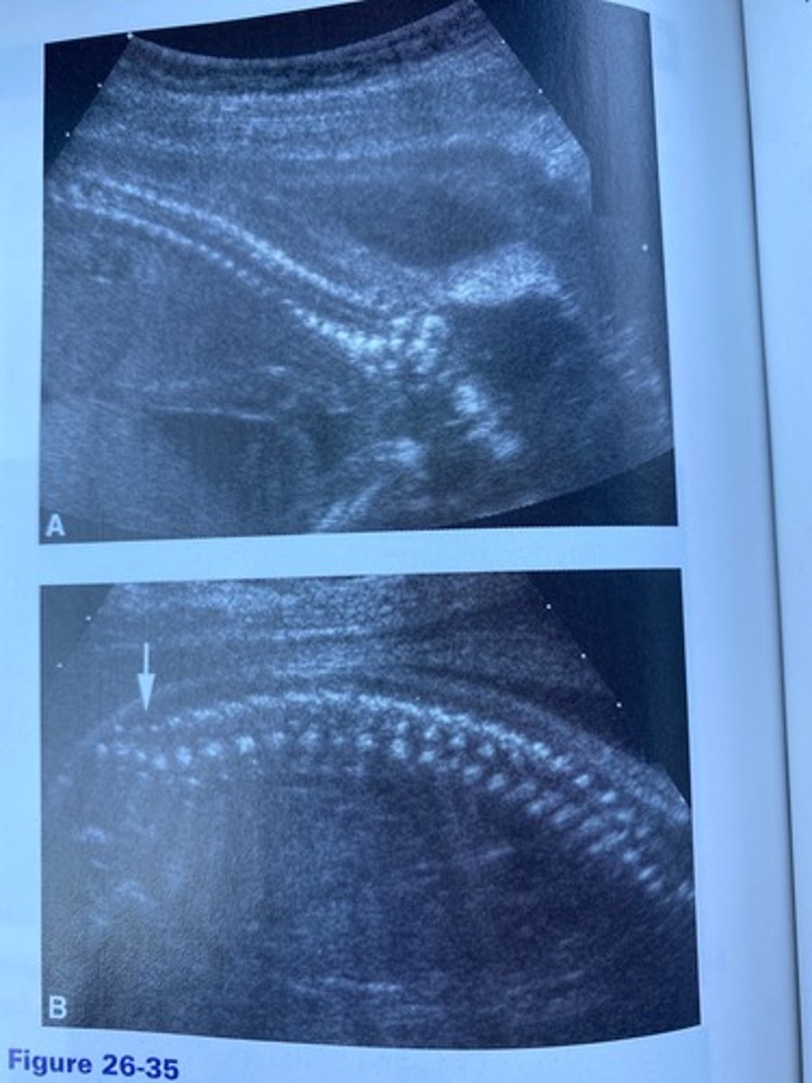 <p>What does the arrow in Figure 26-35 indicate?</p><p>a. Cervical spine</p><p>b. Thoracic spine</p><p>c. Lumbar spine</p><p>d. Sacral spine</p>