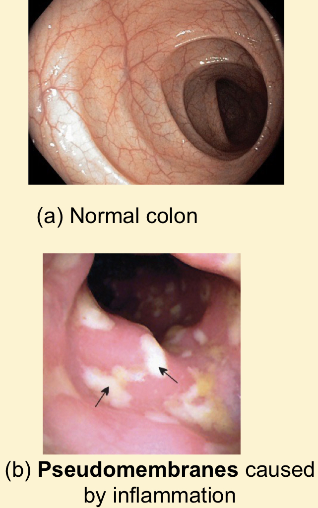 <p></p><ul><li><p>Treatment with broadspectrum antibiotics kill the other bacteria found in the intestines, allowing C. difficile to overgrow</p></li><li><p>Irritation of the large intestine caused by infection</p></li><li><p>If the colon becomes inflammed, membrane like patches form</p></li></ul>