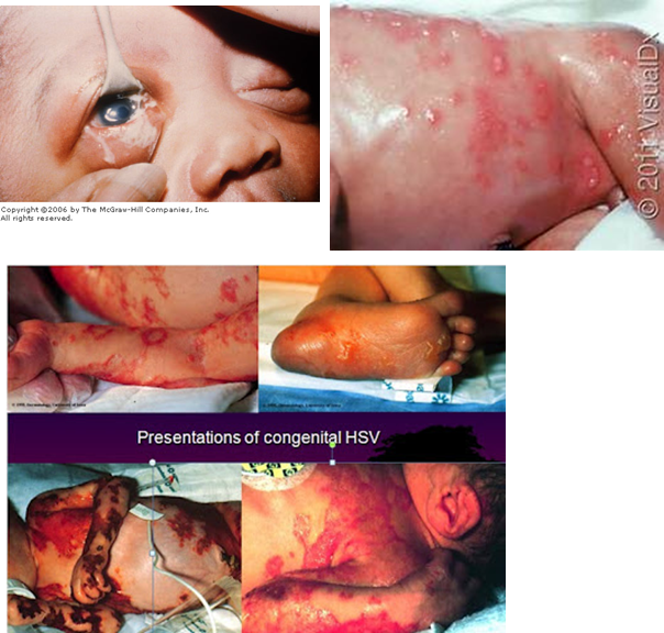 <p>Because the <strong>mother may not show symptoms</strong>, leading to undetected transmission of HSV to the neonate, which can cause severe disease.</p>