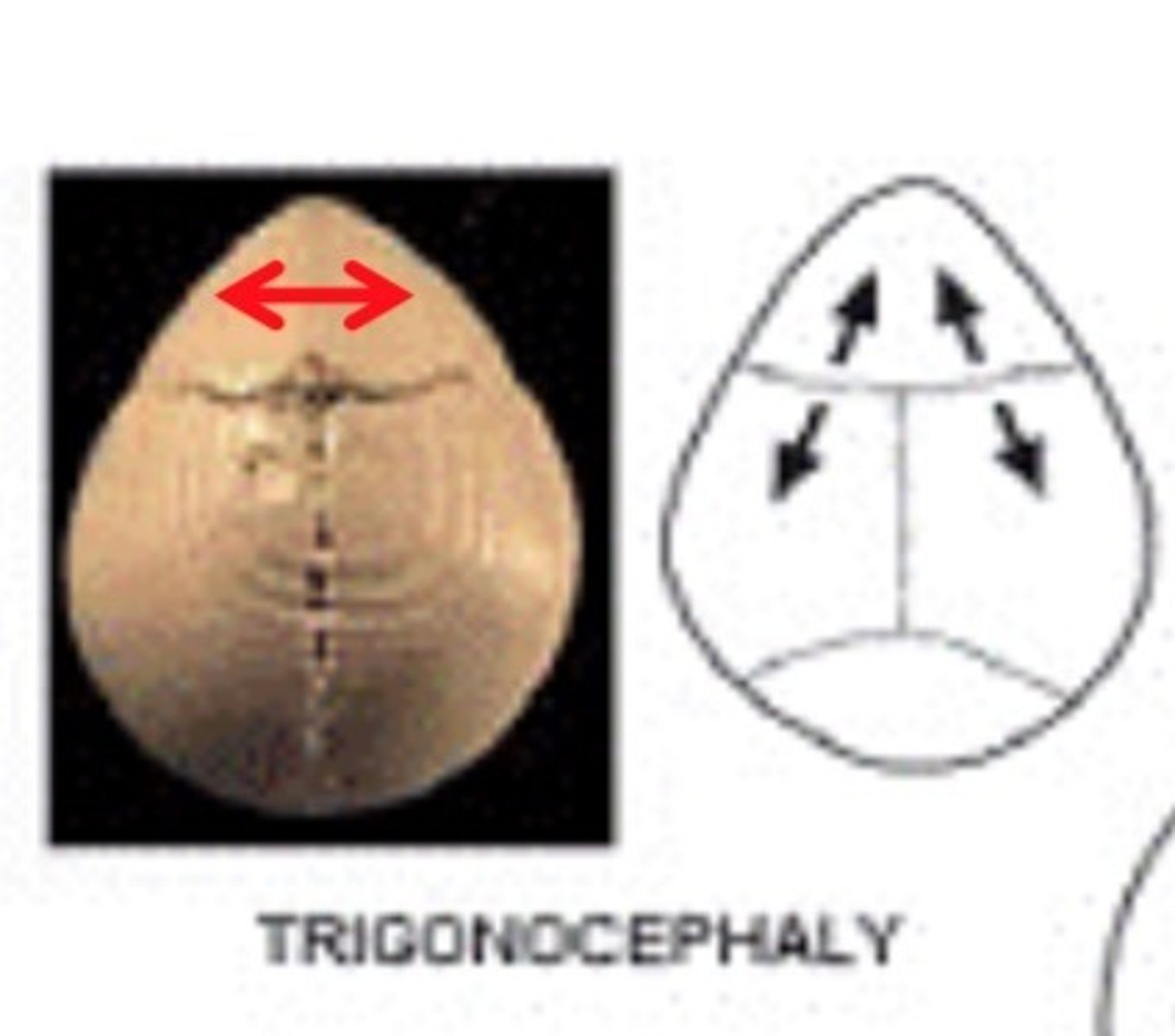 <p>fusion of the frontal suture resulting in elongation at the forehead</p>
