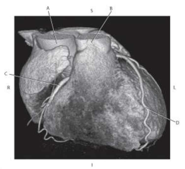 <p>Which line points to the <mark data-color="purple">left anterior descending artery?</mark></p>