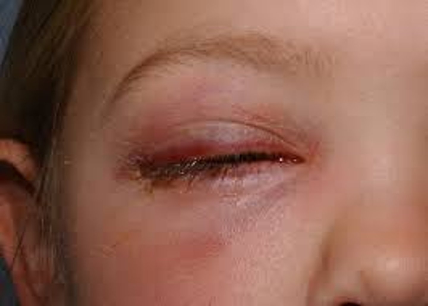 <p>infection (staph and strep) of the eyelid soft tissue anterior to the eyelid septum, commonly spread from adjoining tissues: sinuses, hordeola, dacryo-adenitis/-cystitis</p>