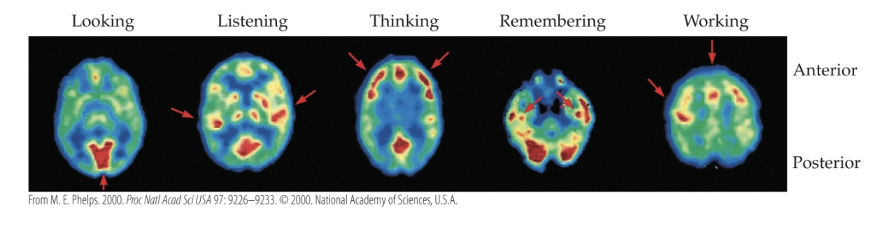 <p>Positron emission tomography (PET): An imaging technology that allows us to define locations in the brain where neurons are especially active by measuring the metabolism of brain cells using safe radioactive isotopes.</p>