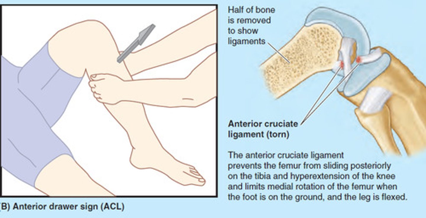 <p>What does it test for?</p><p>- tear of the ACL</p><p>How do you perform it?</p><p>- bending knee at 90 degree, pull knee anteriorly</p><p>- increased anterior gliding of the tibia seen in ACL injury</p><p>Note:</p><p>Lachman test is similar but at 30 degree angle</p>