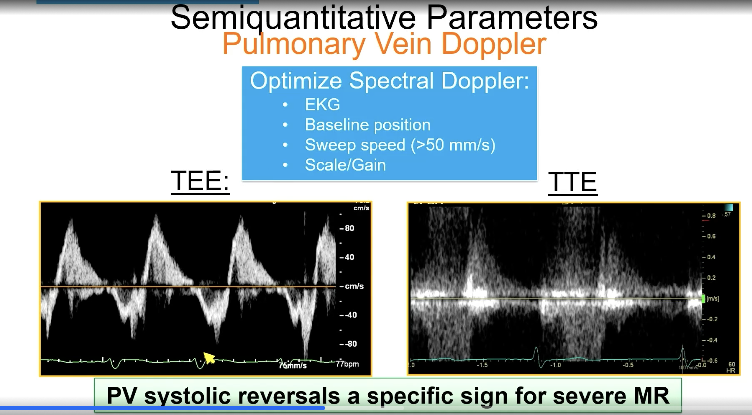 <p>FYI this is PV systolic reversal</p>