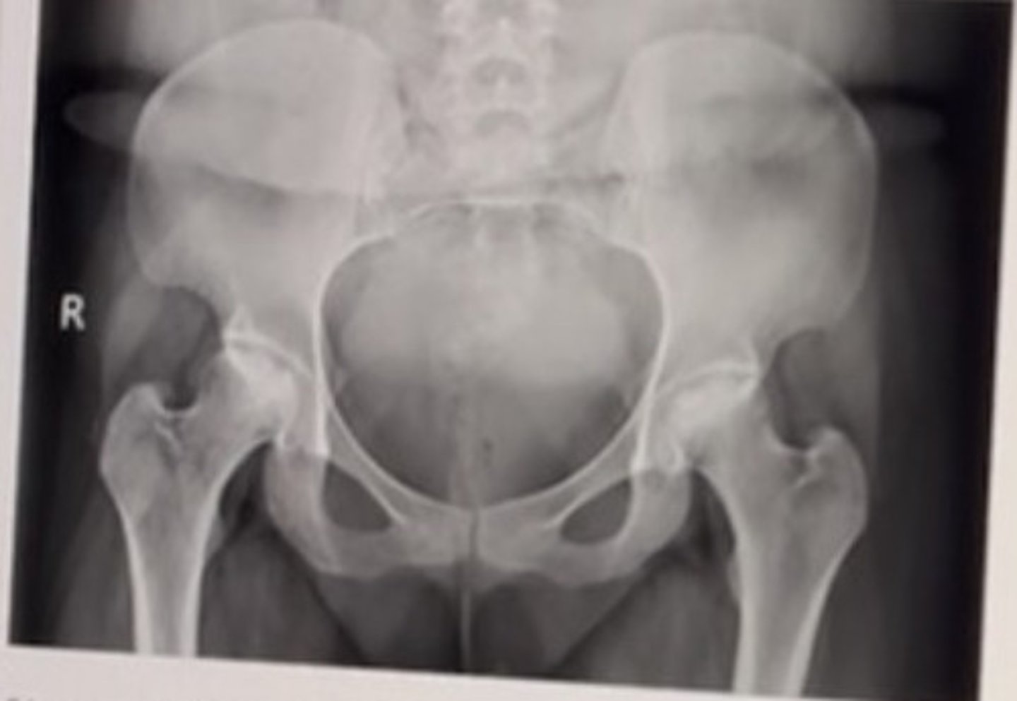 <p>54 year old male with chronic bilateral hip pain. History reveals the patient suffers from alcoholism.</p><p>Best diagnosis:</p><p>• Septic arthritis</p><p>• Paget disease</p><p>• Osteomalacia</p><p>• Avascular necrosis</p>