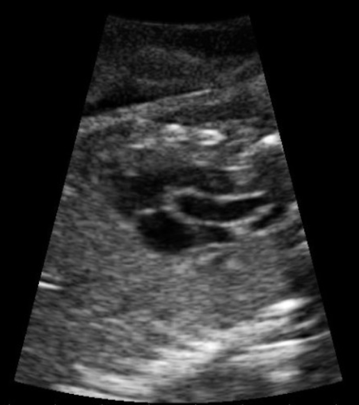 <p>which cardiac view is this</p><p>a) LVOT</p><p>b) RVOT</p><p>c) ductus arteriosus</p><p>d) ductus venosus</p>