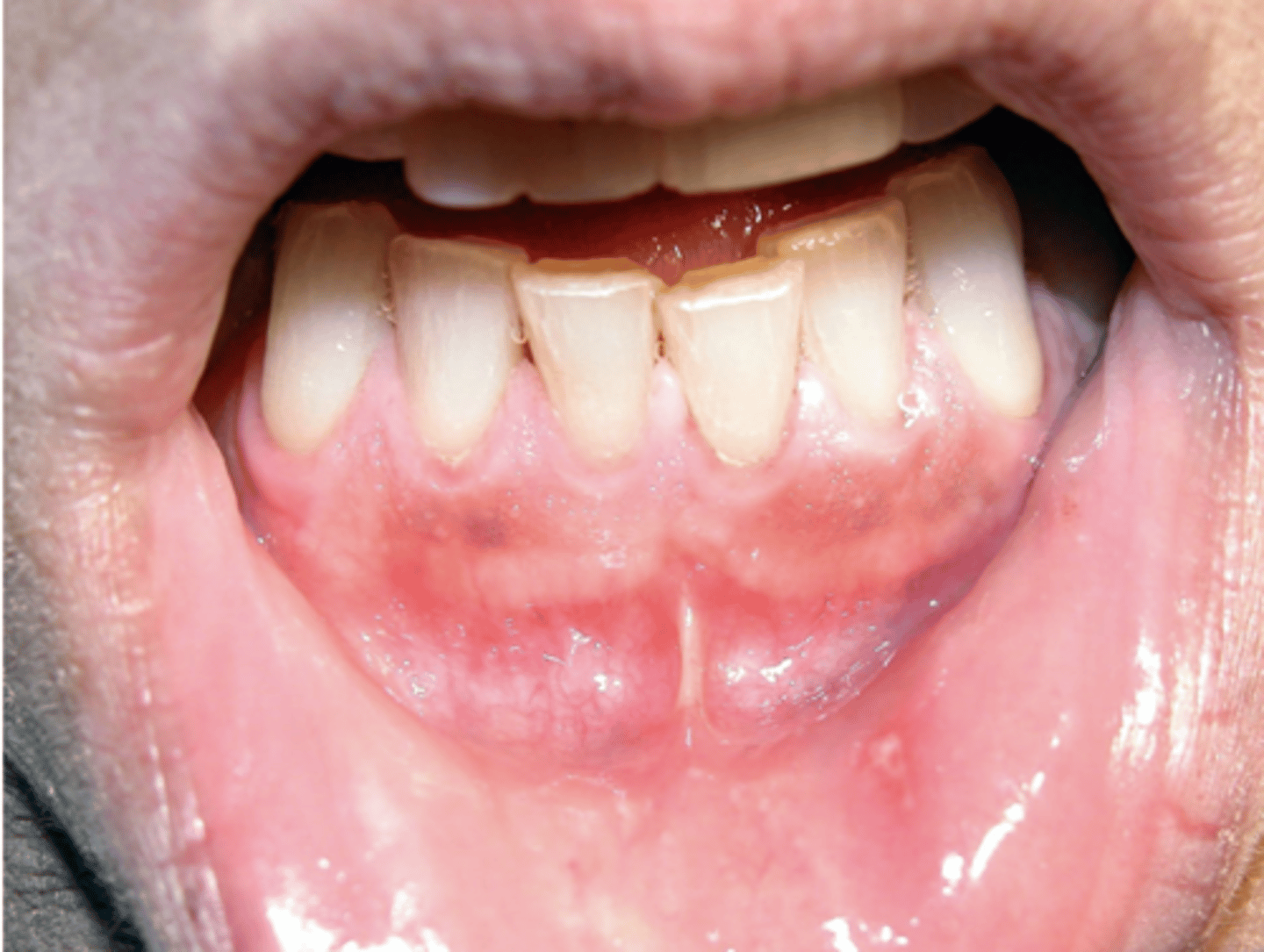 <p>What type of pigmented lesion?</p><p>- Post-inflammatory hyperpigmentation</p><p>- Facial gingiva affected most often</p><p>- May be seen in 20% of smokers</p>