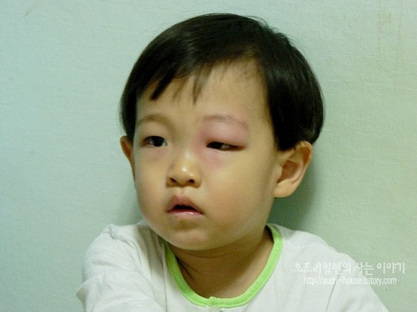 <p>sưng</p>