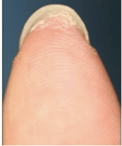 <p>area free under free eye of plate that accumlates the dirt (part of the nail)</p>