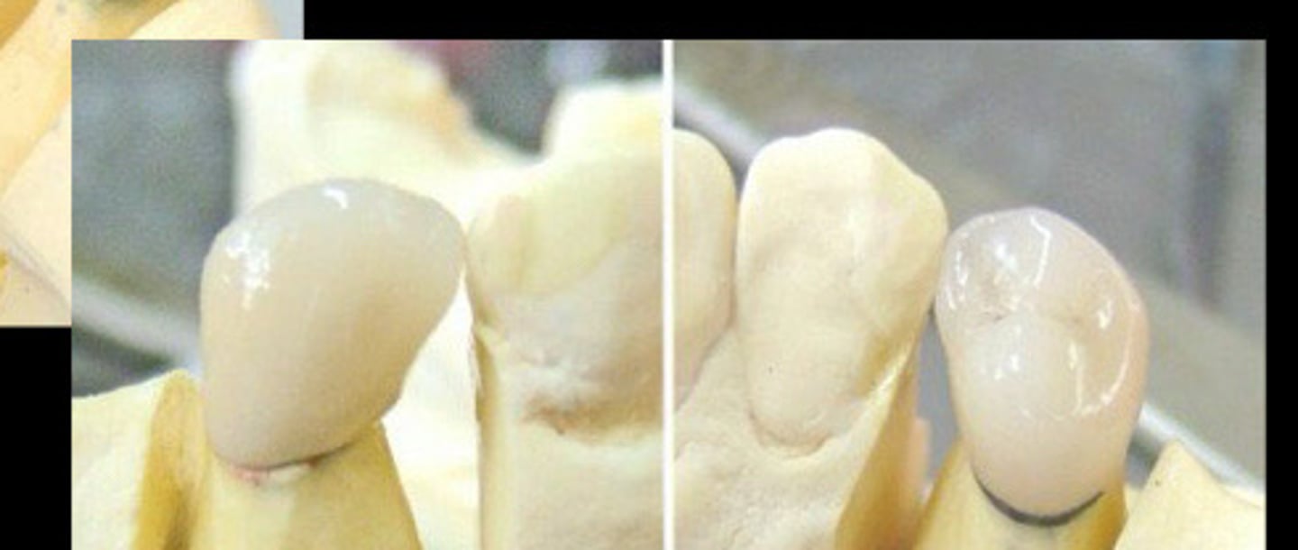 <p>6) after stain, glaze and final firing metal collar on lingual _</p>