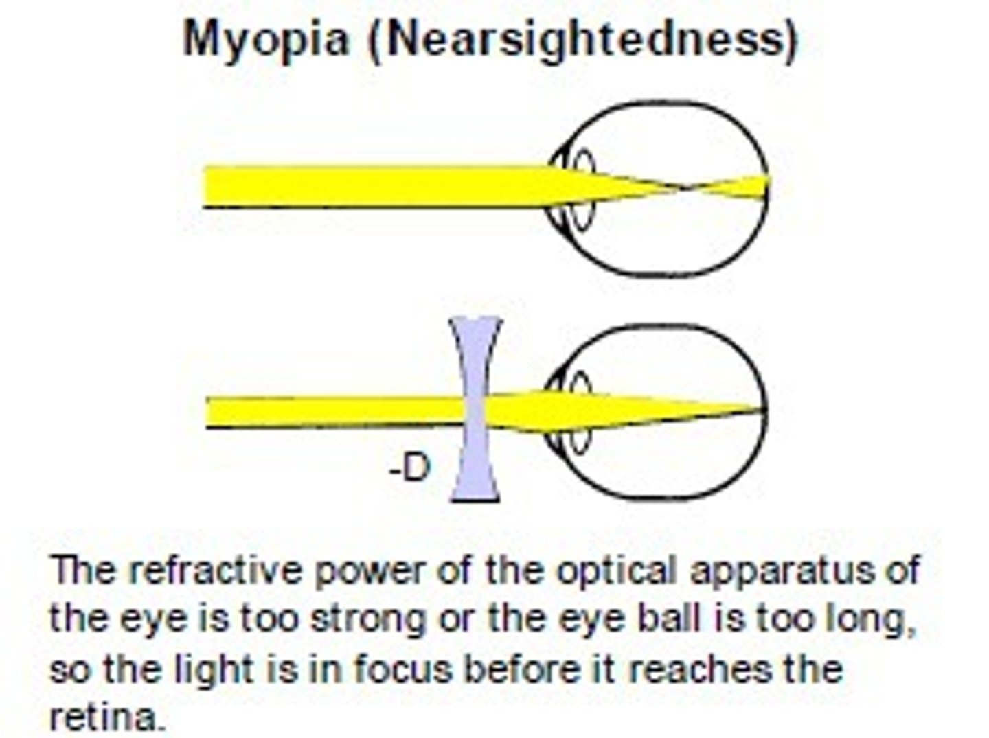 <p>- Eye is too long</p><p>- Rays from distant object focuses in front of the retina</p>