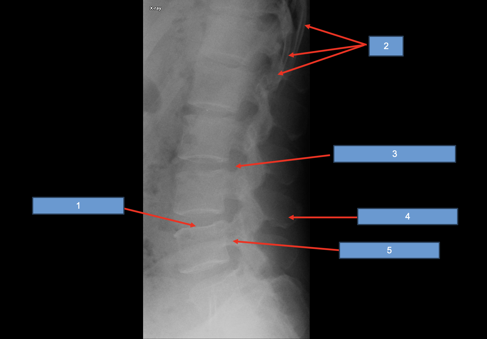 <p>1; what vertebrae are displayed?</p>