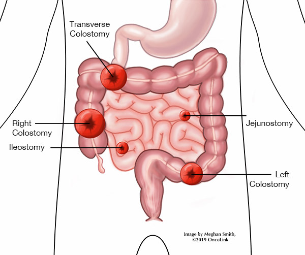 <p>surgical opening by bringing out the ileum (end of small intestine) out onto the surface of the skin. </p><p></p>